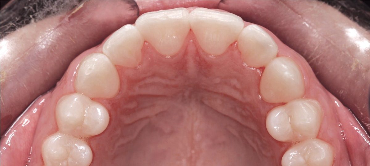 Nach der Behandlung mit unsichtbaren Alignern – gerade und ausgerichtete Zähne